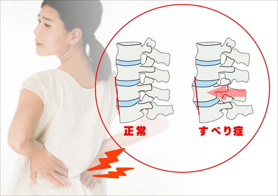 【歩くと腰や脚がつらい…姿勢を変えると少し楽？】それ、“腰椎すべり症”かもしれません