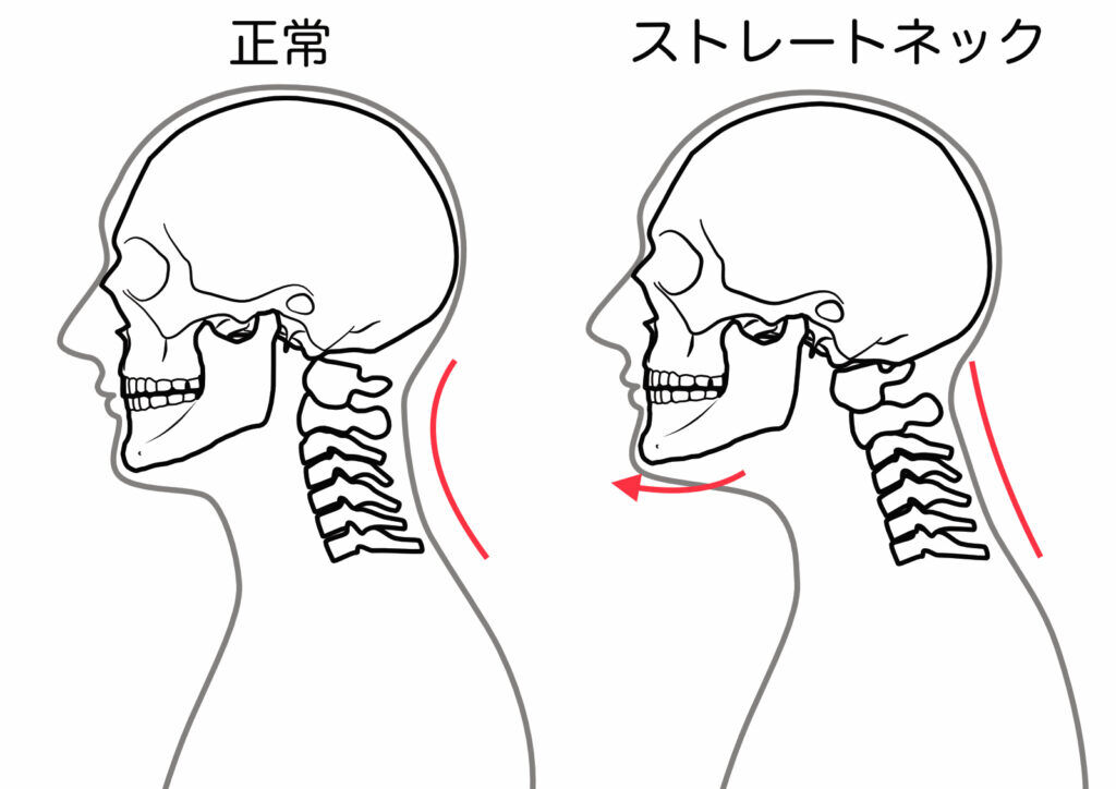 【その肩こり、原因は“ストレートネック”かもしれません】