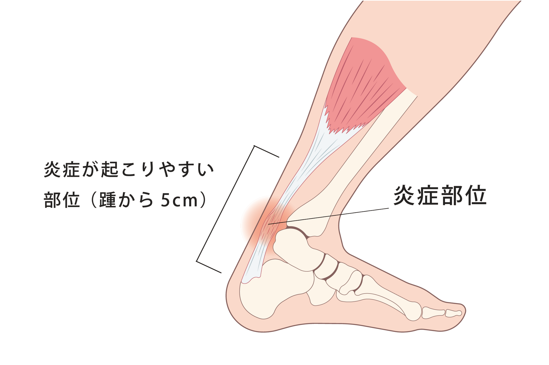 【アキレス腱の違和感・痛み、それ“アキレス腱周囲炎”かもしれません】