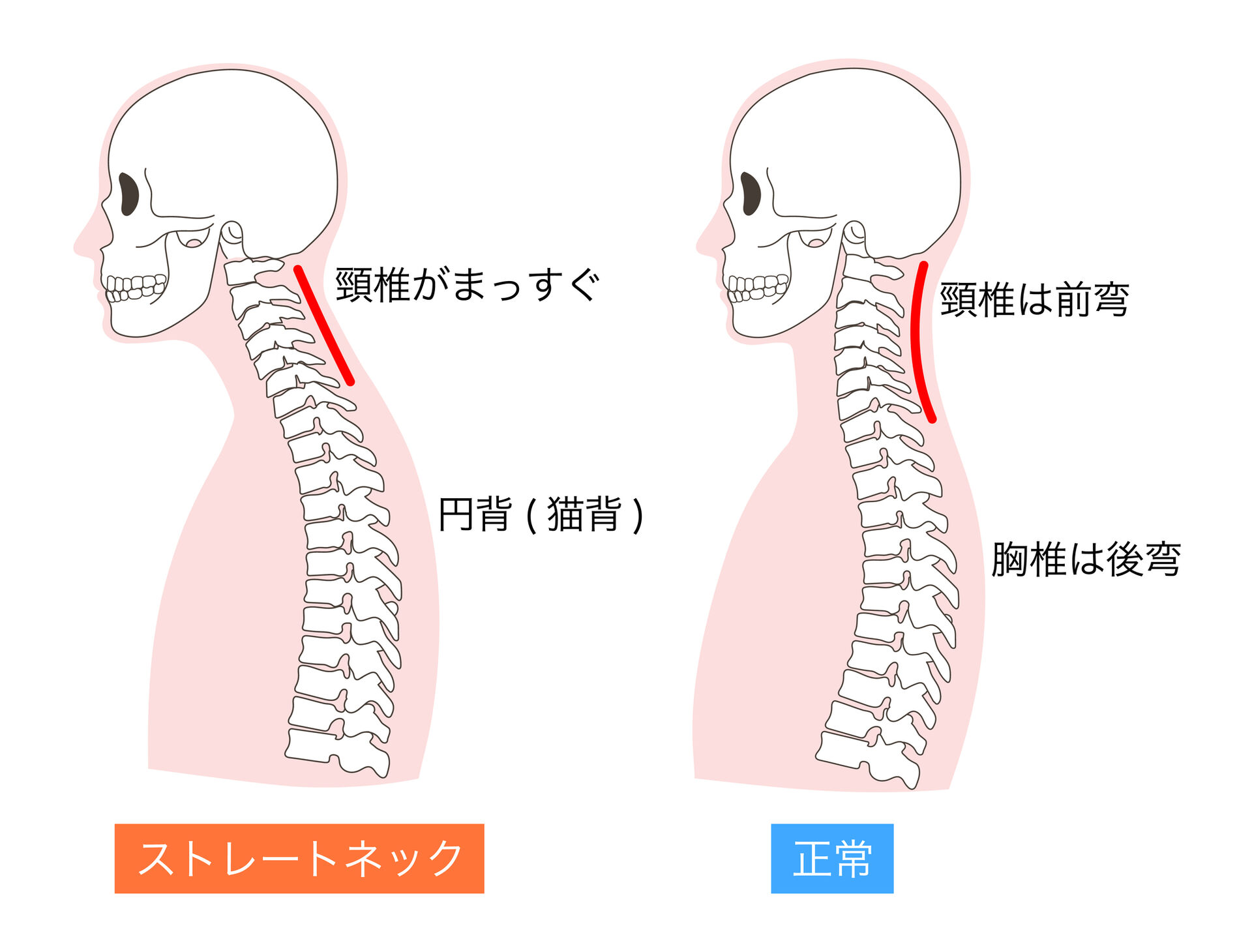 【整体で姿勢矯正｜猫背・反り腰・巻き肩の根本改善へ】