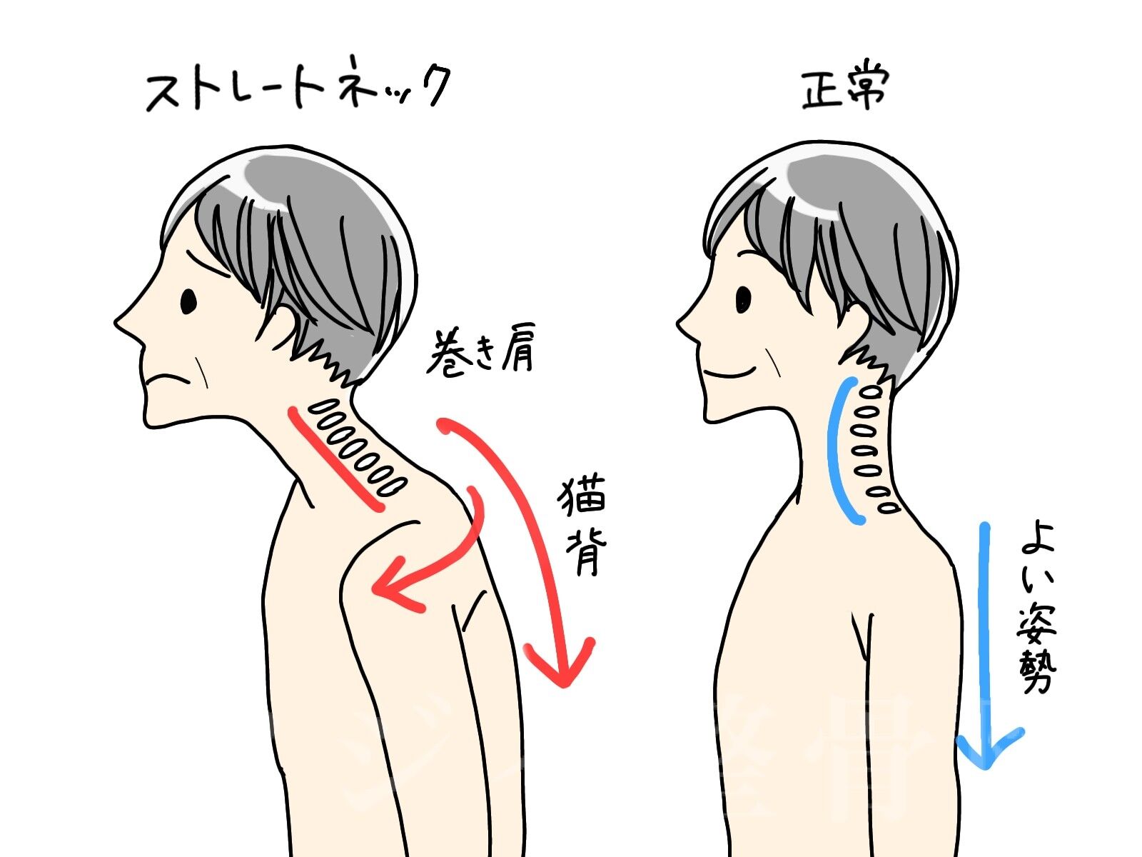 ストレートネックで首や肩がつらい方へ│浜松にしづか整骨院